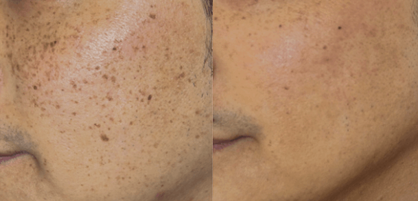 Pigment Laser Before After1