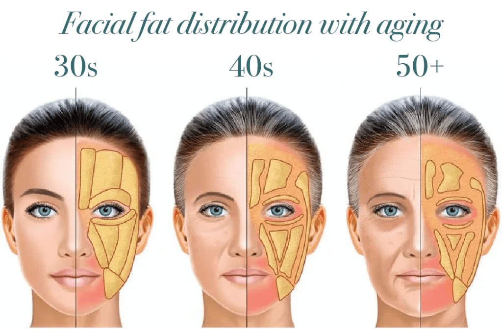 facial fat distribution Facial Fat Distribution