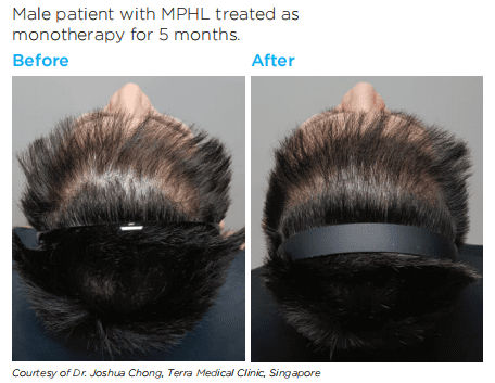 Nourkrin Beforeafter1
