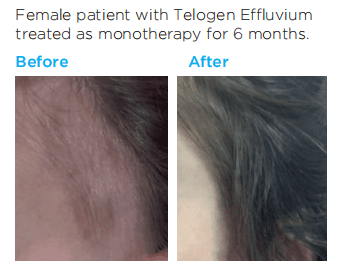 Nourkrin Beforeafter3