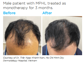 Nourkrin Beforeafter4