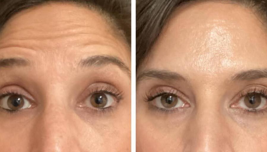 woman before and after botox