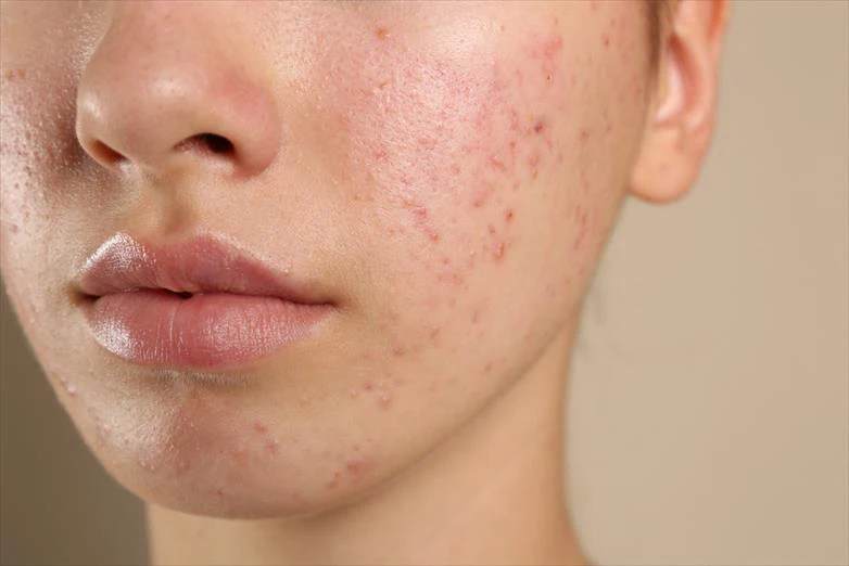 woman with acne on her face